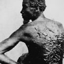 An enslaved man shows his whipping scars