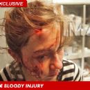 One women was hit by a flying bottle during the Drake/ Chris Brown fight. It required 16 stitches to close.