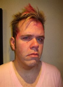 Perez Hilton After Assault