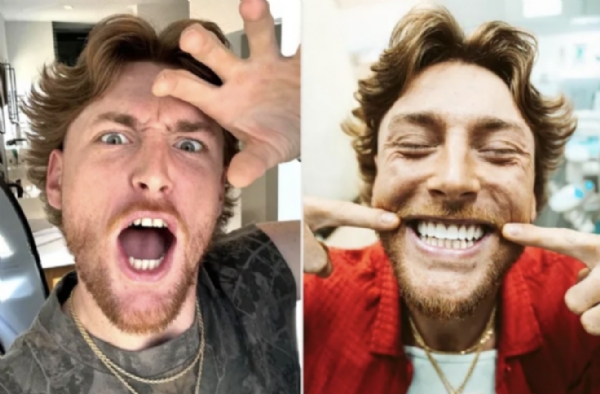 Bailey Zimmerman Reveals His New Veneers, Giving Him "The Smile I've Always Dreamed Of"