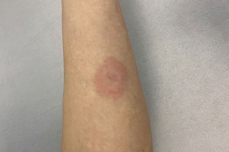 Lenawee County Faces Rise in Lyme Disease Cases, Health Officials Urge Precaution